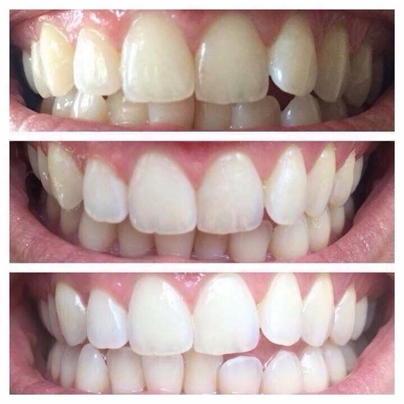 Whitening Toothpaste - Picture 13 of 16